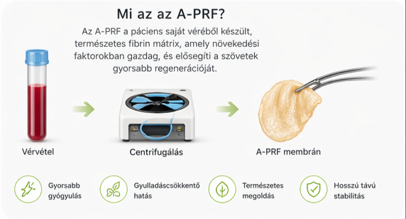 A-PRF alkalmazása